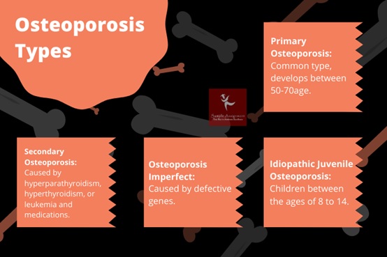 osteoporosis nursing assignment help